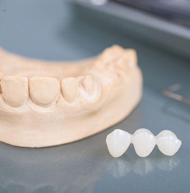 Dental Bridges